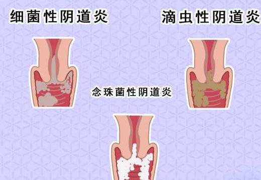 陰道分泌物午夜福利理论片在线观看剖析什麽是細菌性陰道炎
