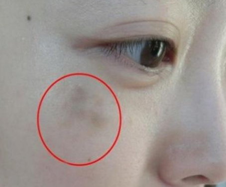 婦科陰道分泌物午夜福利理论片在线观看提醒女人婦科炎症在臉上的表現
