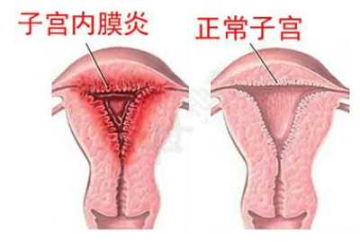 全自動陰道分泌物午夜福利理论片在线观看廠家子宮內膜炎的症狀表現提前了解與預防