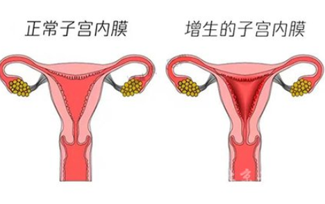 白帶常規午夜福利理论片在线观看廠家解讀子宮內膜增生是什麽原因引起的