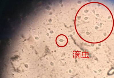 白帶午夜AV剧场品牌科普滴蟲性陰道炎是因為體內長了蟲子嗎