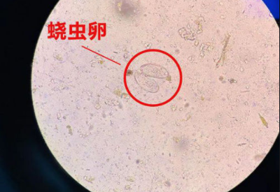 陰道分泌物午夜福利理论片在线观看警惕外陰繞蟲病易在兒童身上出現