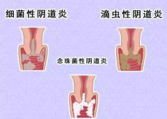 全自動陰道分泌物午夜福利理论片在线观看廠家提醒您還在拖延嗎，還在等陰道炎自愈嗎？