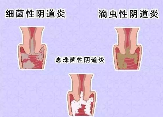 全自動陰道分泌物午夜福利理论片在线观看廠家提醒您還在拖延嗎，還在等陰道炎自愈嗎？
